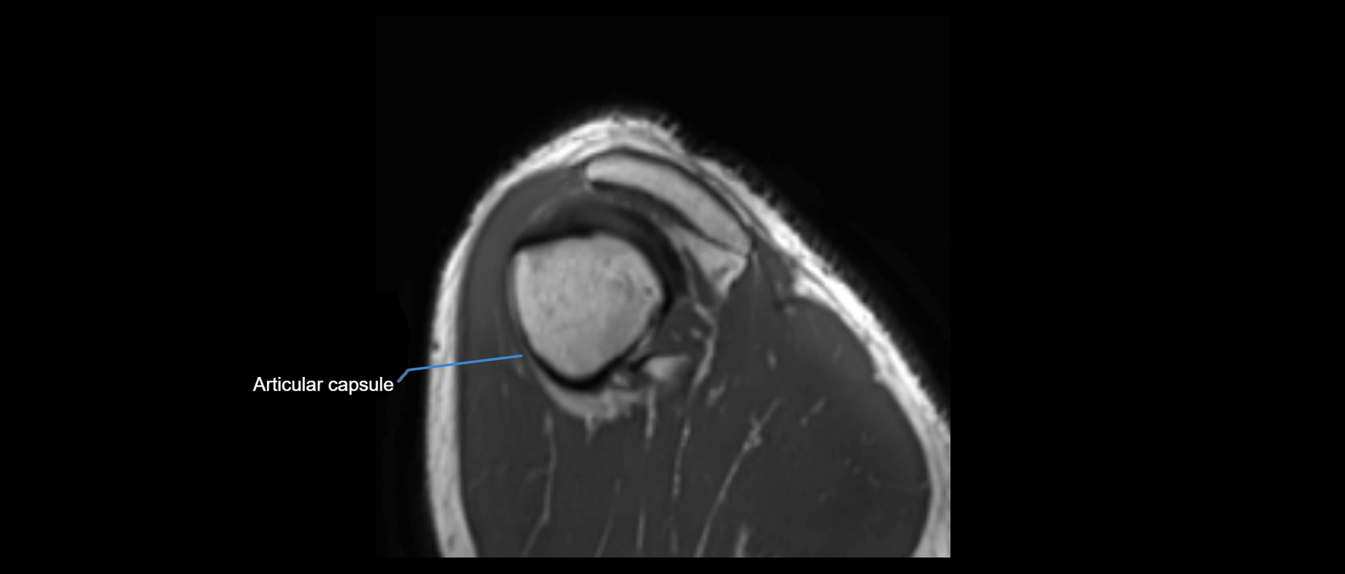 shoulder ligaments sagittal  cross sectional anatomy 3T MRI AI enhanced radiology image -img-00001-00051.webp